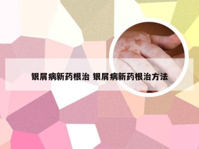 银屑病新药根治 银屑病新药根治方法