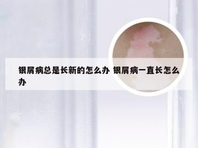 银屑病总是长新的怎么办 银屑病一直长怎么办