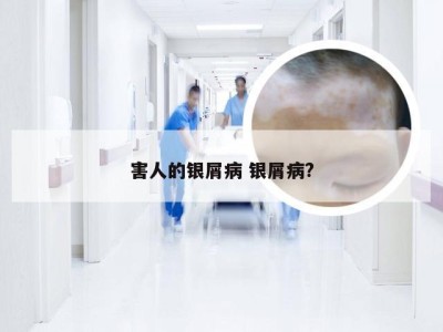 害人的银屑病 银屑病?