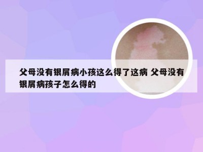 父母没有银屑病小孩这么得了这病 父母没有银屑病孩子怎么得的