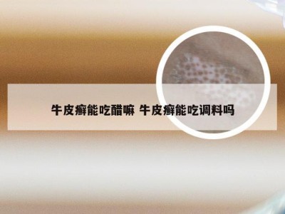 牛皮癣能吃醋嘛 牛皮癣能吃调料吗