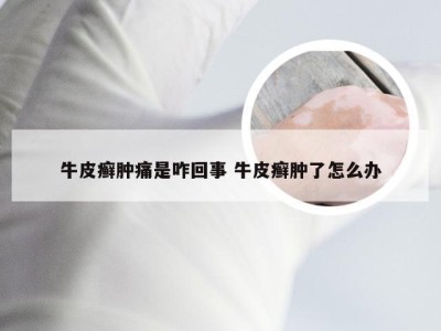 牛皮癣肿痛是咋回事 牛皮癣肿了怎么办