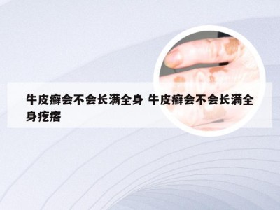牛皮癣会不会长满全身 牛皮癣会不会长满全身疙瘩