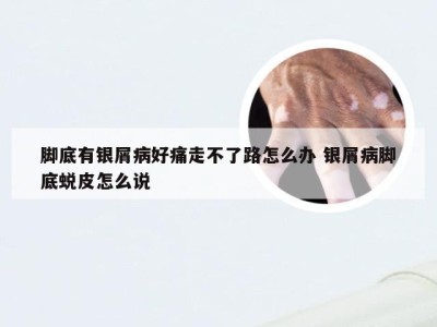 脚底有银屑病好痛走不了路怎么办 银屑病脚底蜕皮怎么说
