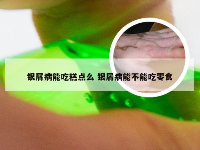 银屑病能吃糕点么 银屑病能不能吃零食
