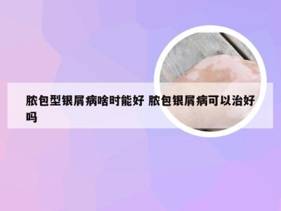 脓包型银屑病啥时能好 脓包银屑病可以治好吗