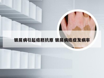 银屑病引起癌胚抗原 银屑病癌症发病率