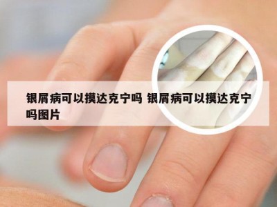 银屑病可以摸达克宁吗 银屑病可以摸达克宁吗图片