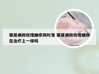 银屑病和玫瑰糠疹同时发 银屑病和玫瑰糠疹在治疗上一样吗
