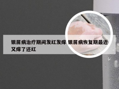 银屑病治疗期间发红发痒 银屑病恢复期最近又痒了还红