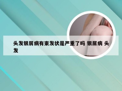 头发银屑病有束发状是严重了吗 银屑病 头发