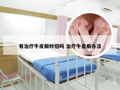 有治疗牛皮癣妙招吗 治疗牛皮癣办法