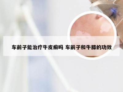 车前子能治疗牛皮癣吗 车前子和牛膝的功效