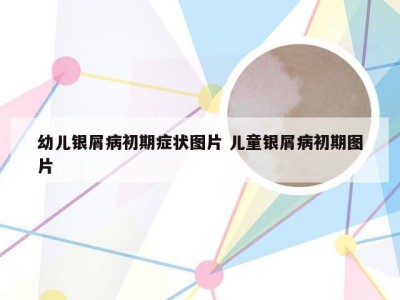 幼儿银屑病初期症状图片 儿童银屑病初期图片