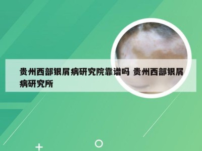 贵州西部银屑病研究院靠谱吗 贵州西部银屑病研究所