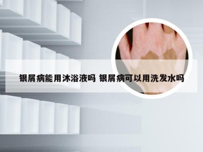 银屑病能用沐浴液吗 银屑病可以用洗发水吗