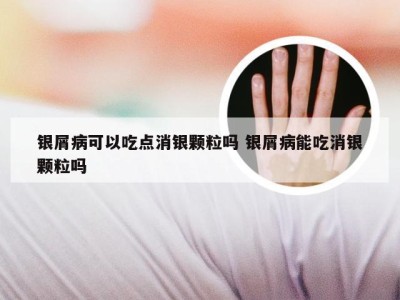 银屑病可以吃点消银颗粒吗 银屑病能吃消银颗粒吗