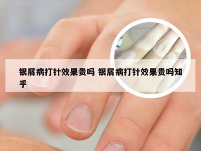 银屑病打针效果贵吗 银屑病打针效果贵吗知乎