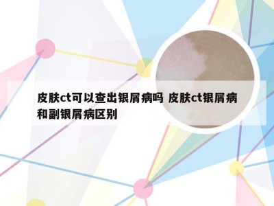 皮肤ct可以查出银屑病吗 皮肤ct银屑病和副银屑病区别