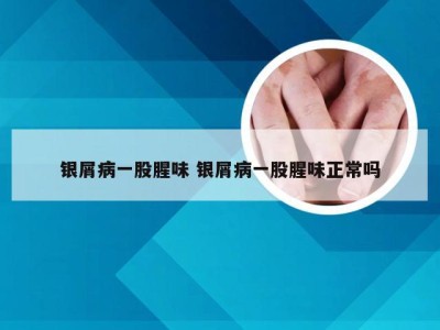 银屑病一股腥味 银屑病一股腥味正常吗
