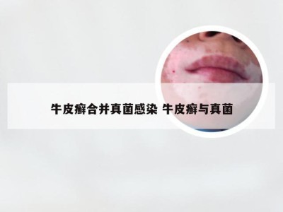 牛皮癣合并真菌感染 牛皮癣与真菌
