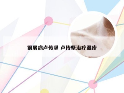 银屑病卢传坚 卢传坚治疗湿疹