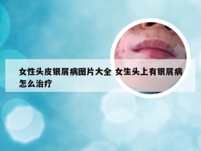 女性头皮银屑病图片大全 女生头上有银屑病怎么治疗
