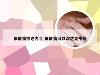 银屑病搽达力士 银屑病可以涂达克宁吗