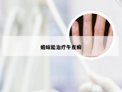 蟾蜍能治疗牛皮癣
