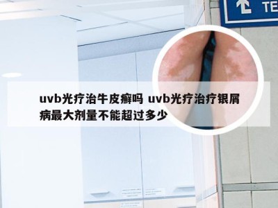 uvb光疗治牛皮癣吗 uvb光疗治疗银屑病最大剂量不能超过多少