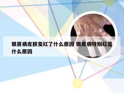 银屑病皮肤变红了什么原因 银屑病特别红是什么原因