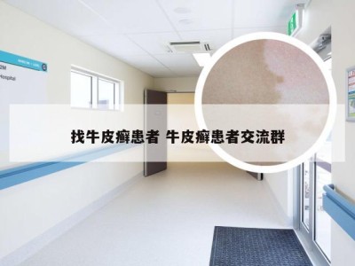 找牛皮癣患者 牛皮癣患者交流群