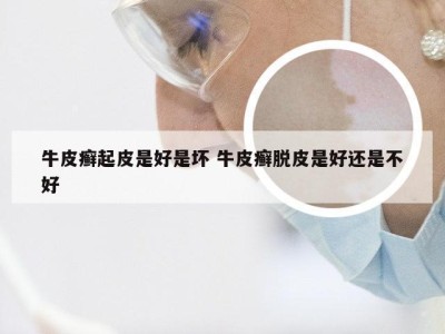 牛皮癣起皮是好是坏 牛皮癣脱皮是好还是不好