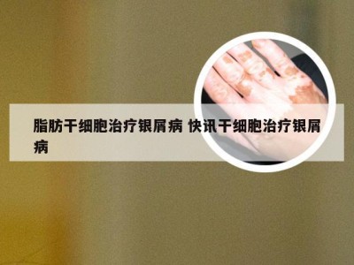 脂肪干细胞治疗银屑病 快讯干细胞治疗银屑病
