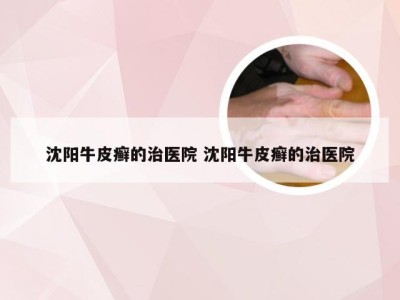 沈阳牛皮癣的治医院 沈阳牛皮癣的治医院