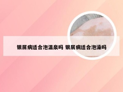 银屑病适合泡温泉吗 银屑病适合泡澡吗