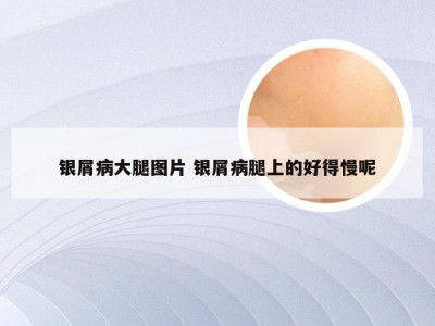 银屑病大腿图片 银屑病腿上的好得慢呢