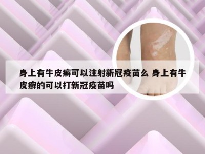 身上有牛皮癣可以注射新冠疫苗么 身上有牛皮癣的可以打新冠疫苗吗