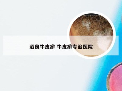 酒泉牛皮癣 牛皮癣专治医院