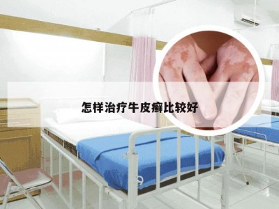 怎样治疗牛皮癣比较好