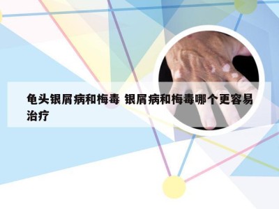 龟头银屑病和梅毒 银屑病和梅毒哪个更容易治疗