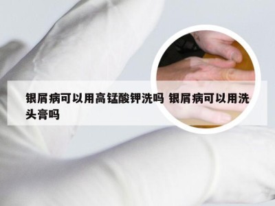 银屑病可以用高锰酸钾洗吗 银屑病可以用洗头膏吗