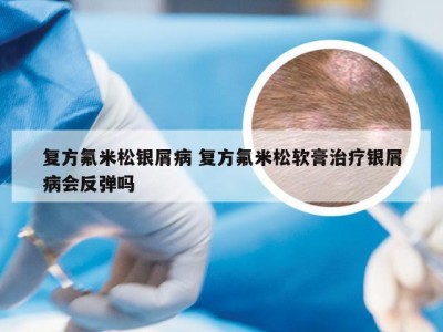 复方氟米松银屑病 复方氟米松软膏治疗银屑病会反弹吗