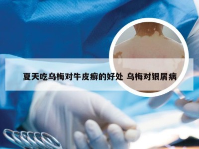 夏天吃乌梅对牛皮癣的好处 乌梅对银屑病