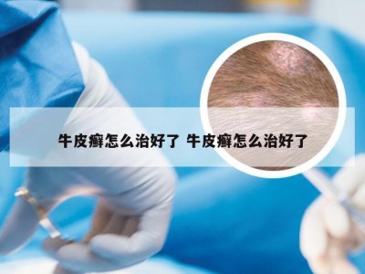 牛皮癣怎么治好了 牛皮癣怎么治好了