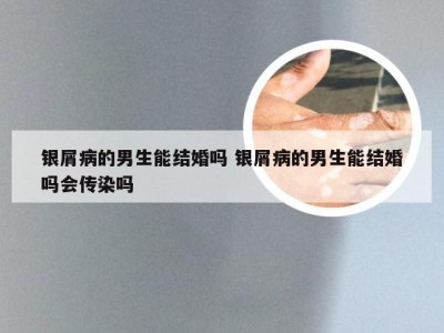 银屑病的男生能结婚吗 银屑病的男生能结婚吗会传染吗