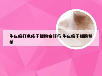 牛皮癣打免疫干细胞会好吗 牛皮癣干细胞移植