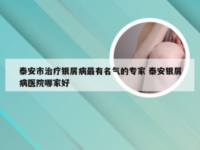 泰安市治疗银屑病最有名气的专家 泰安银屑病医院哪家好