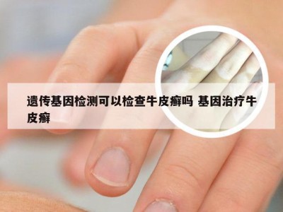 遗传基因检测可以检查牛皮癣吗 基因治疗牛皮癣