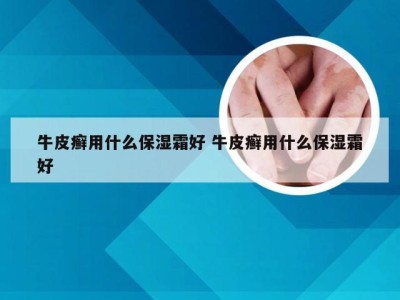 牛皮癣用什么保湿霜好 牛皮癣用什么保湿霜好